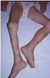 Left hip abnormal positioning