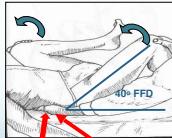 Thomas Test positioning