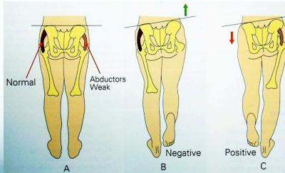 Trendelenburg Test setup