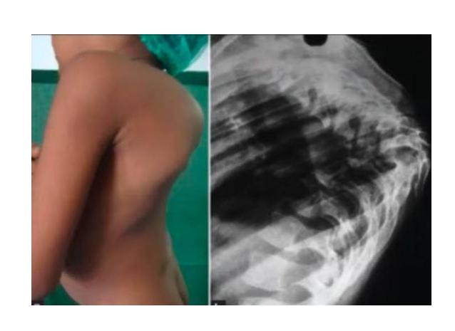 Flexion distraction injury|332x242