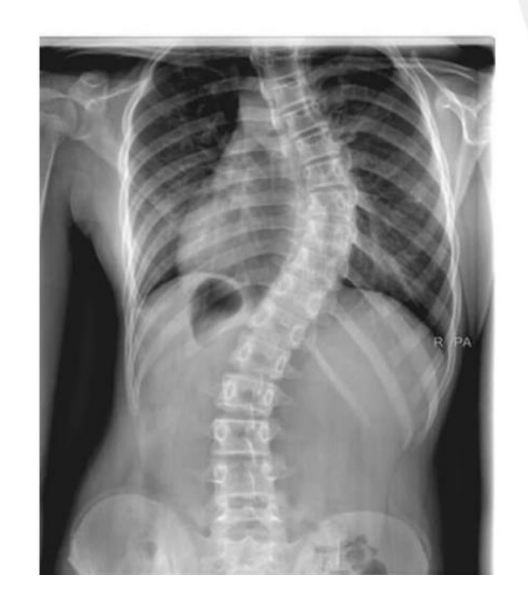 Adam's test positive|376x432