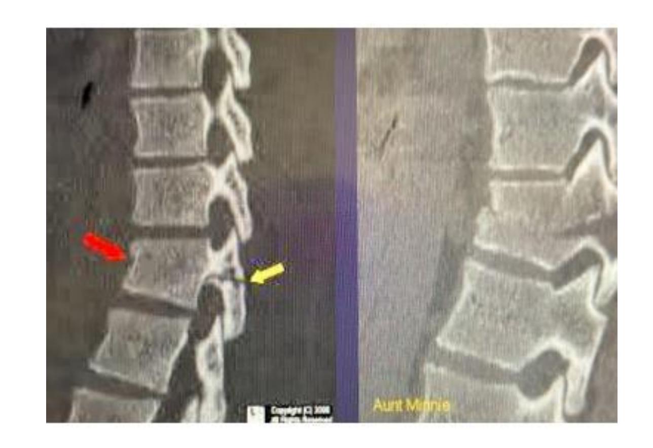 Flexion distraction case|346x237