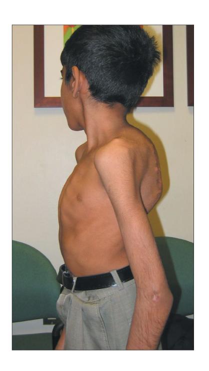 Gibbus deformity case|246x437