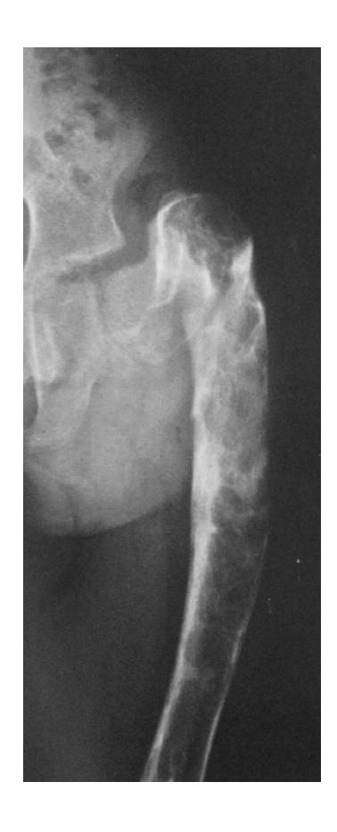 Fibrous dysplasia X-ray|0x0