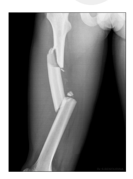 Segmental case|347x468