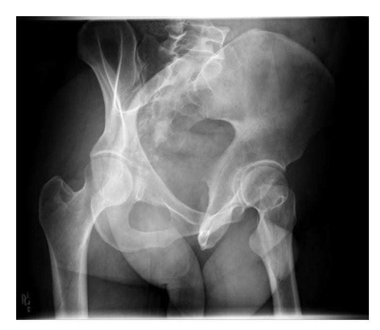 Anterior column view|430x373