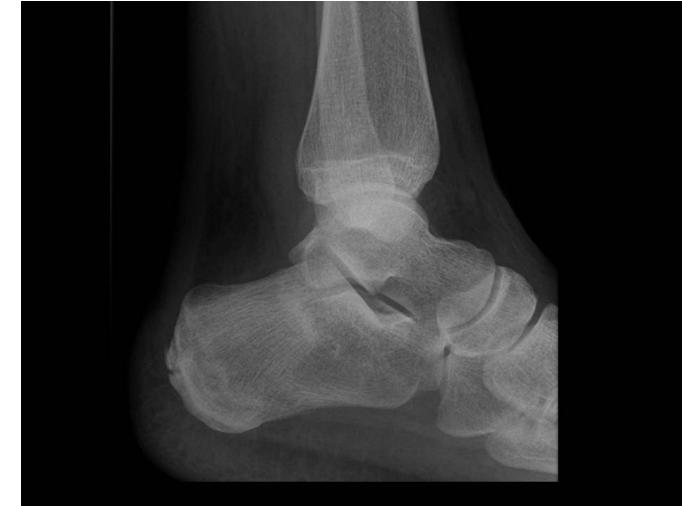 Calcaneus fracture case|439x326