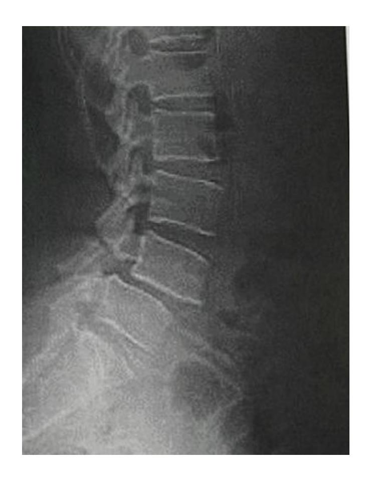 Chronic back pain X-ray|302x391