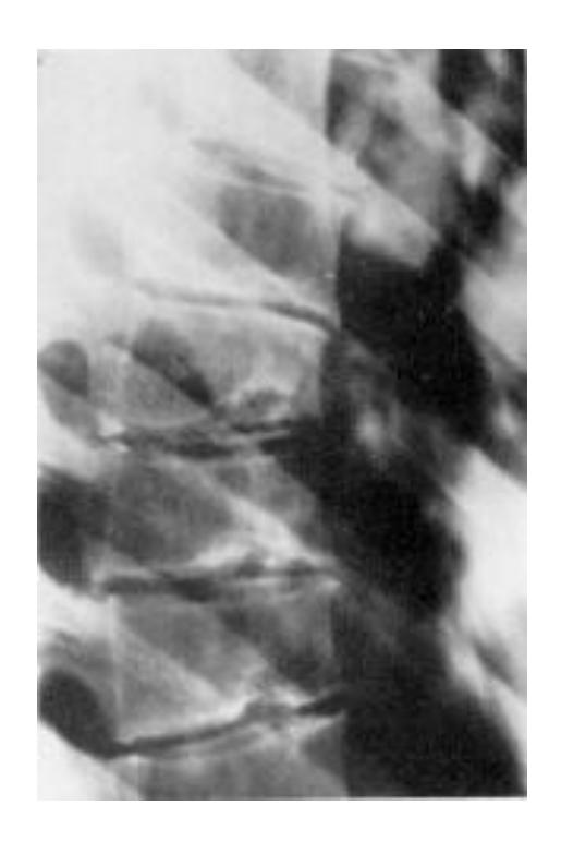 Scheuermann's Disease X-ray 1|279x418