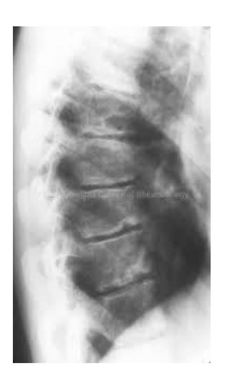 Scheuermann's Disease X-ray 2|248x415
