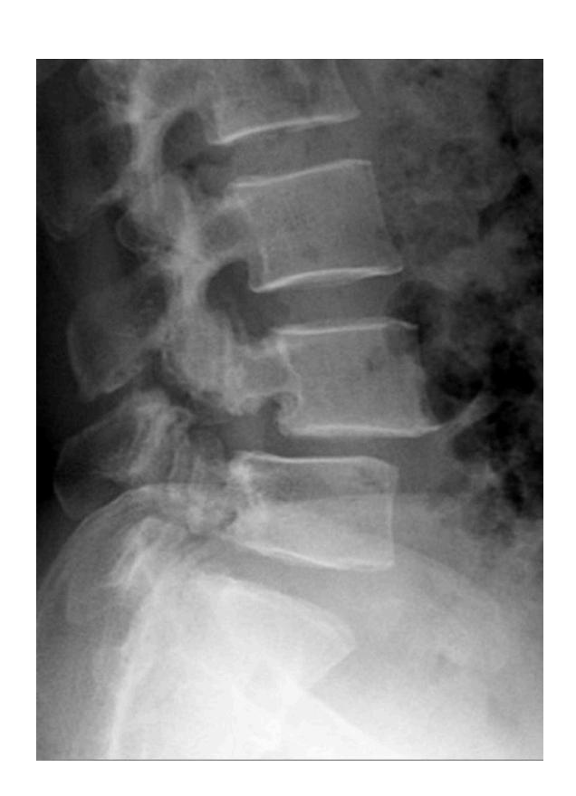 Spondylolisthesis X-ray|263x363