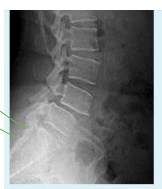 L4-L5 spondylolisthesis|329x383