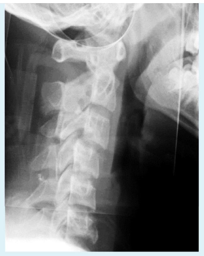 Cervical spondylolisthesis|361x453