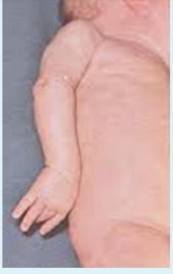 Clinical examination of newborn with upper limb weakness