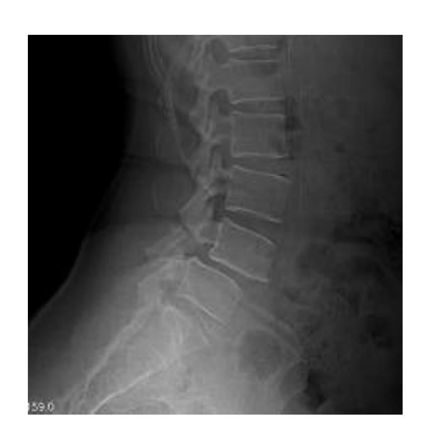 Spondylolisthesis case|422x436