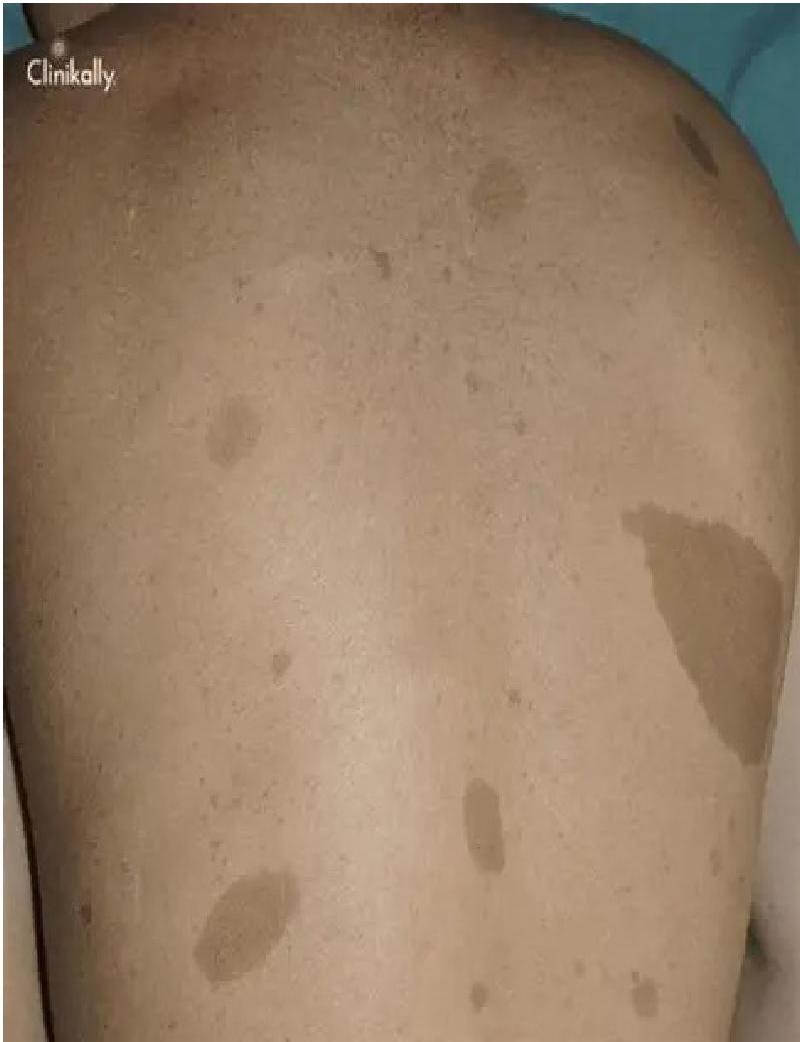 Café-au-lait macules