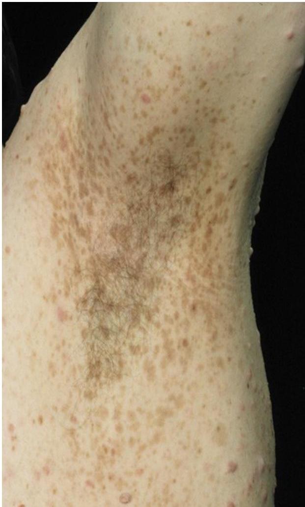 Café-au-lait macules