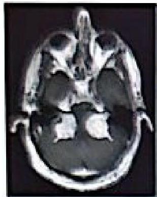 Bilateral Vestibular Schwannoma