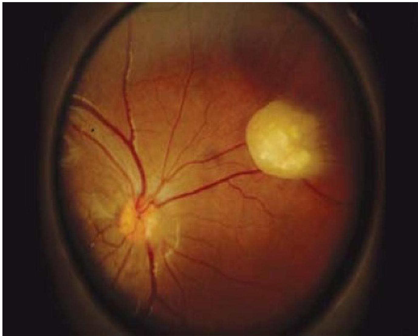 Retinal hamartoma