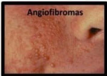 Angiofibroma