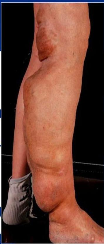 Plexiform neurofibroma