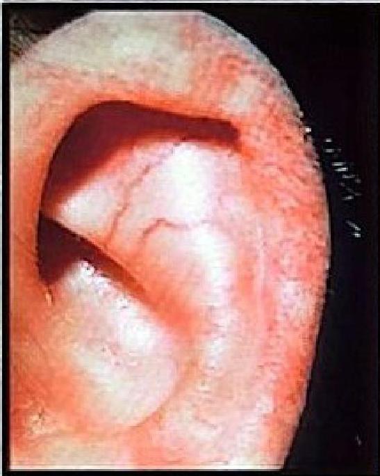 Ocular Telangiectasia