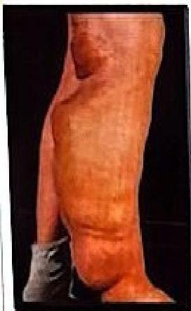 Café-au-lait macules