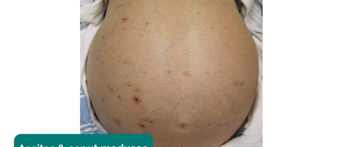 Ascites & caput medusae