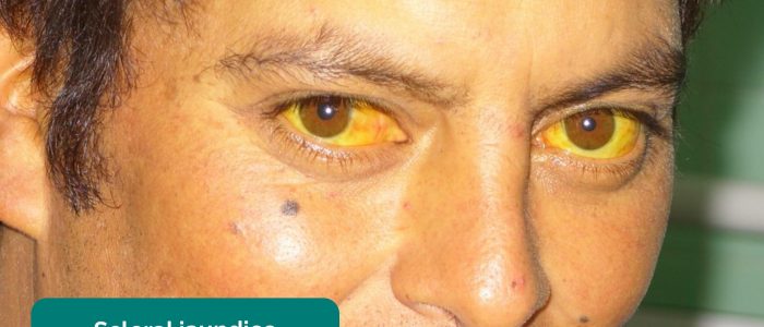 Scleral jaundice