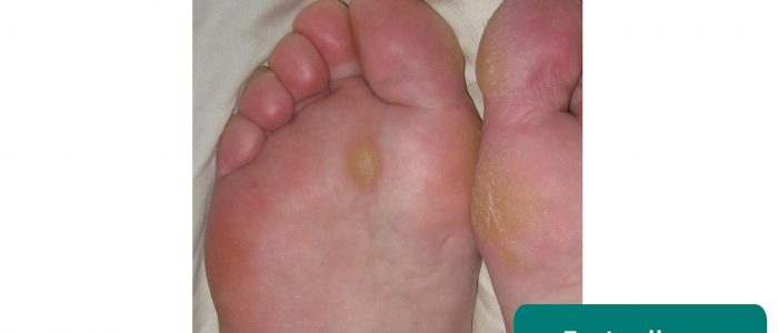 Plantar callus