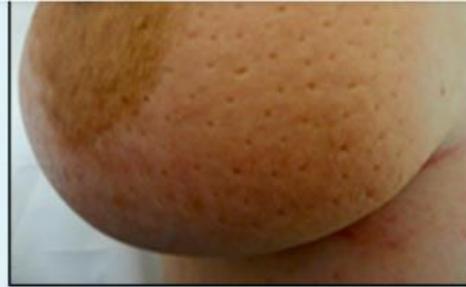 Peau d'orange, nipple inversion|304