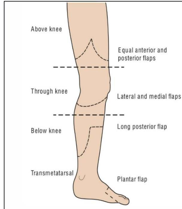 Amputation flaps