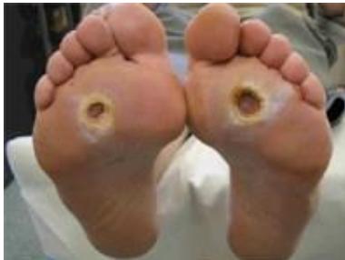 Ulcer edges
