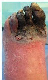 Ulcer depth