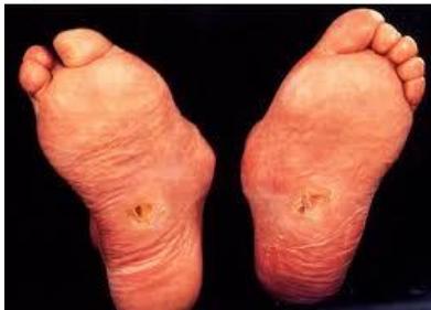 Perilesional erythema