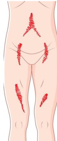 Varicose Veins