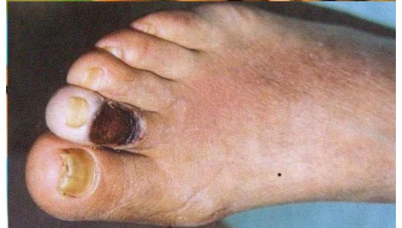 Arterial ulcer toe
