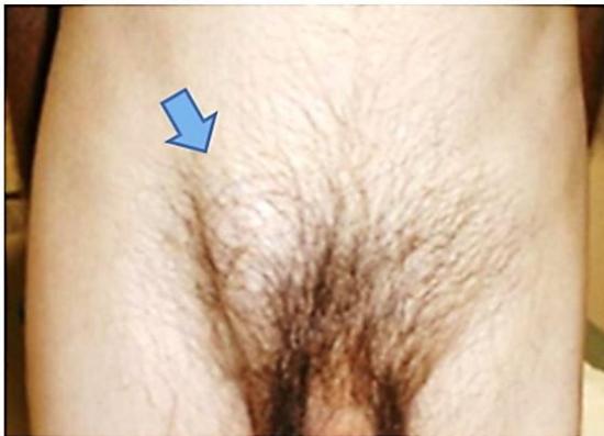 Right Inguinal Hernia Inspection